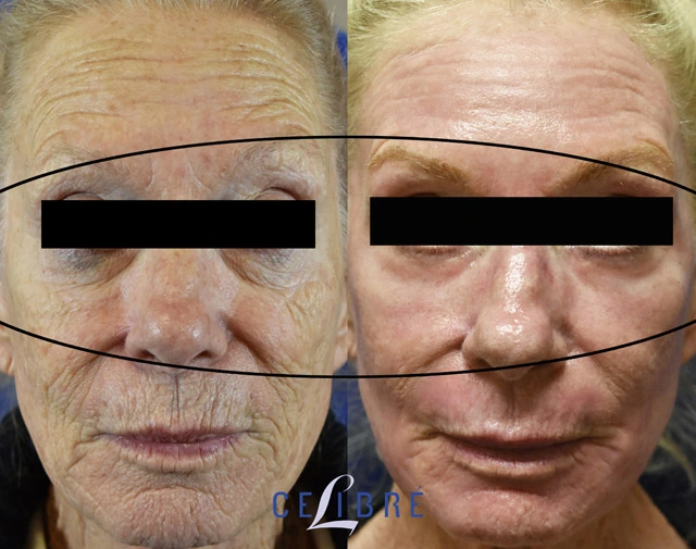How to erase fine lines under the eyes using hydration, retinol, sunscreen, sleep, gentle care, and treatments for smoother skin.