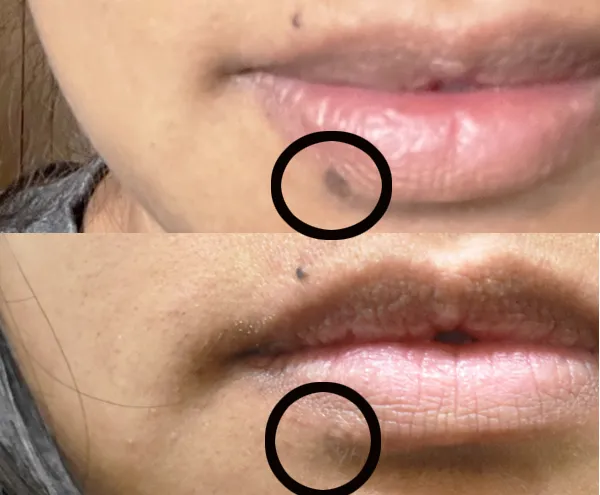 Lip-spot-removal-before-and-af shows smoother, clearer lips with visible dark spot reduction.