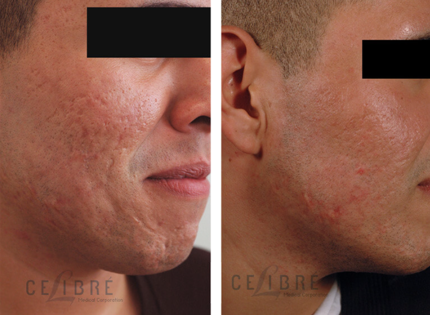 Acne Scar Texture Treatment