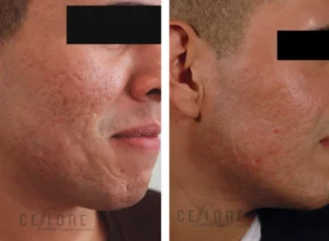 Acne Scar Texture Treatment