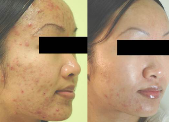 Acne patient