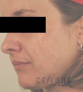 Blue Light Acne Treatment