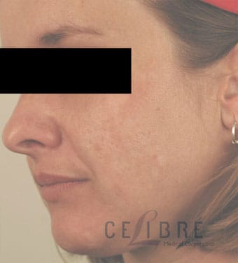 Blue Light Acne Treatment