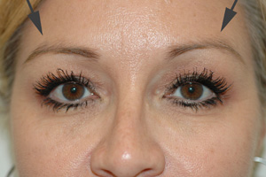 wrinkles above eyebrows