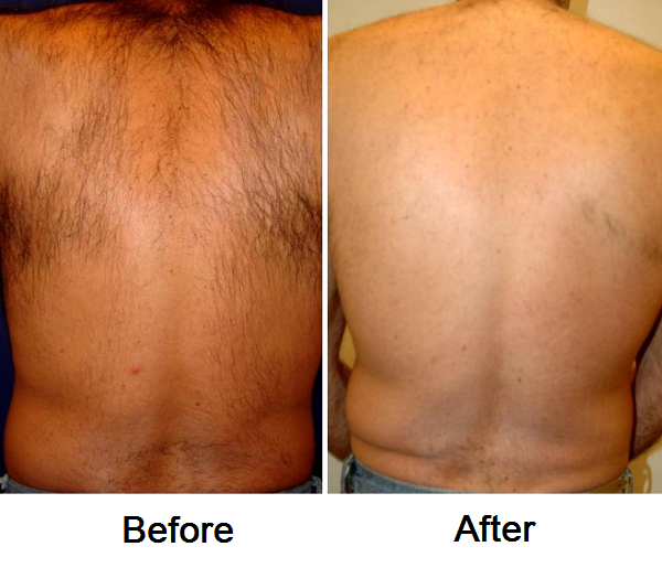 Laser Back Hair Removal