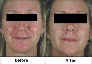 Rosacea treatment before and after photos