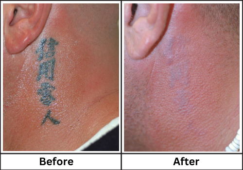 Lutronic - Have you heard that tattoo removal requires several treatments?  Well, we have proof with the right device it can be done fast! #InkFreeMD  #Houston removed this 30-year-old professional #tattoo in
