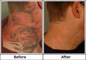 Lasers Remove Tattoos befor and after image