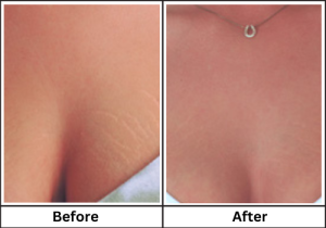 laser stretch mark removal before and after