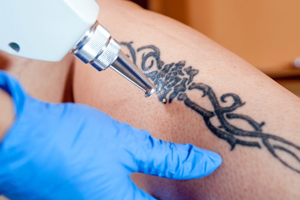 Best Lasers for Tattoo Removal