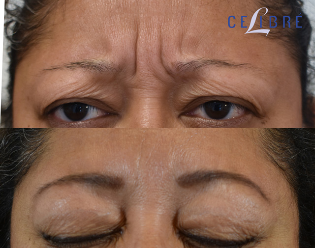 Botox Before and After Pictures: Real Results from Real Patients