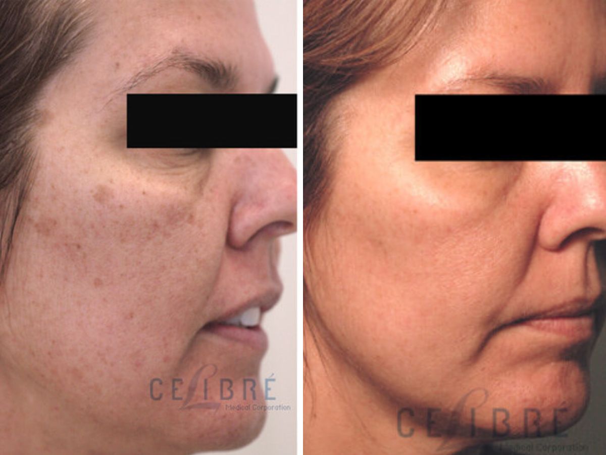 Brown Spots on Face Before and After