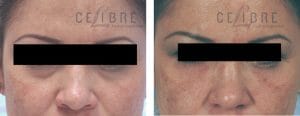 restylane vs botox