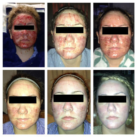 Deep Profractional Laser Resurfacing