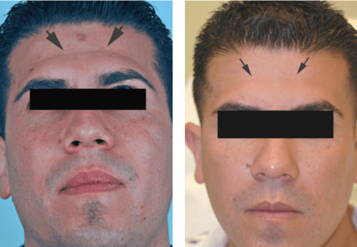 Dermal-Fillers
