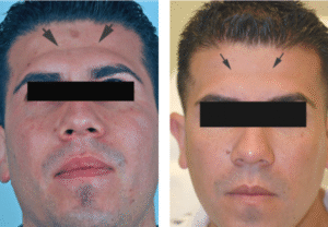 dermal fillers for men