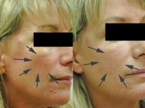 Dermal Fillers for Cheekbones