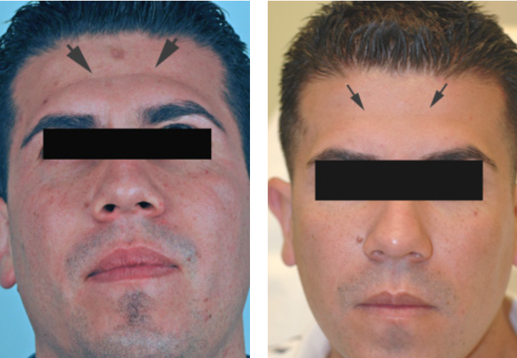 Dermal Fillers