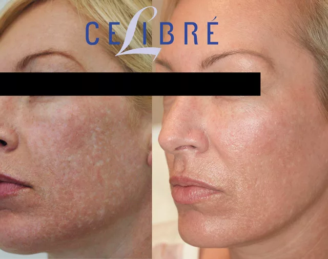 Does Laser Acne Scar Removal Work