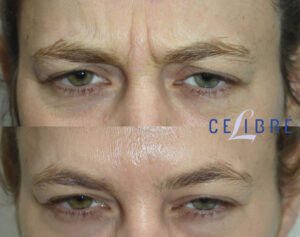 Dysport how long to take effect