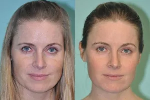 Erbium Laser Resurfacing