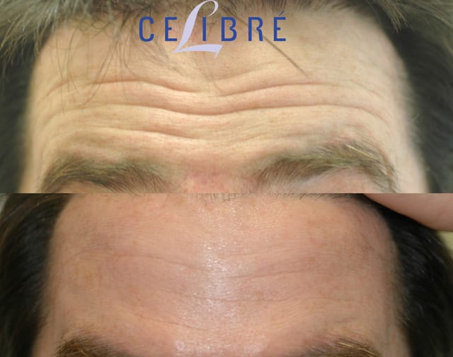 Forehead Botox