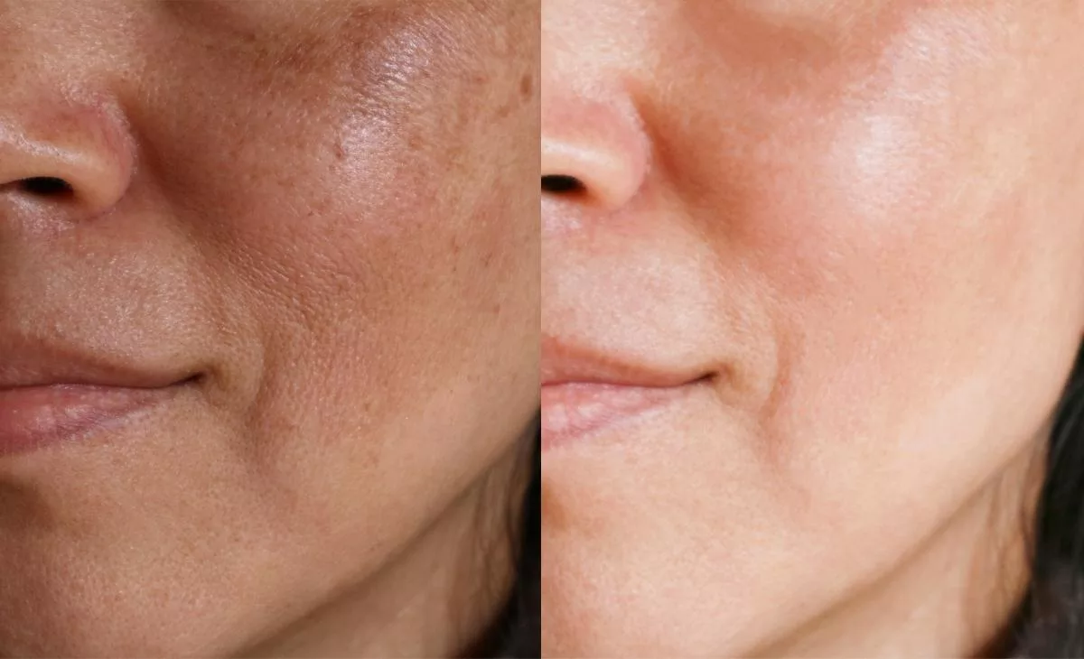 The Safe & Effective Way to Get Rid of Age Spots