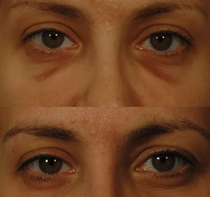 Hemosiderin Staining