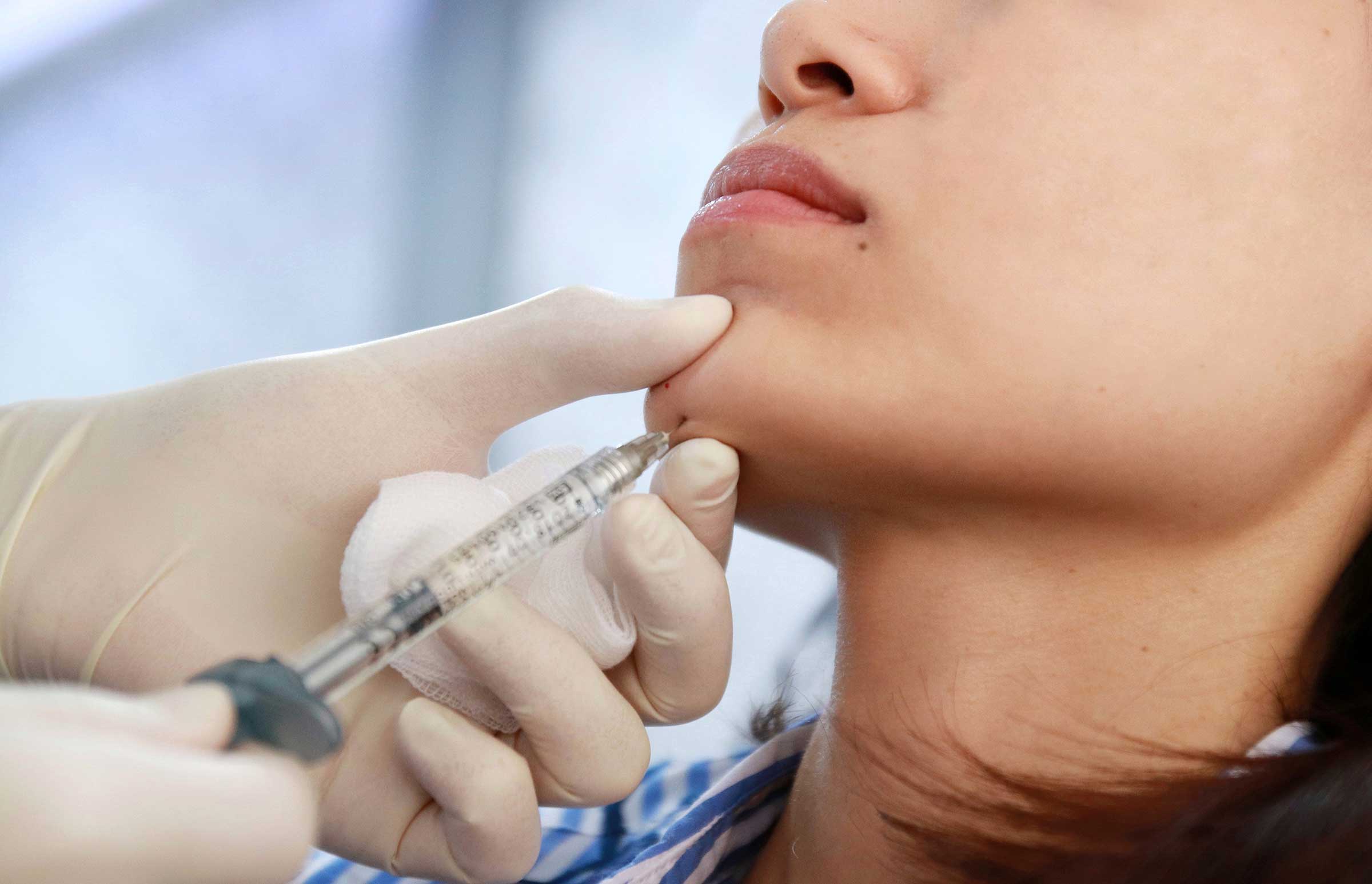 How Long Do Chin Fillers Last