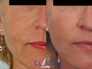How Long Does Sculptra Last