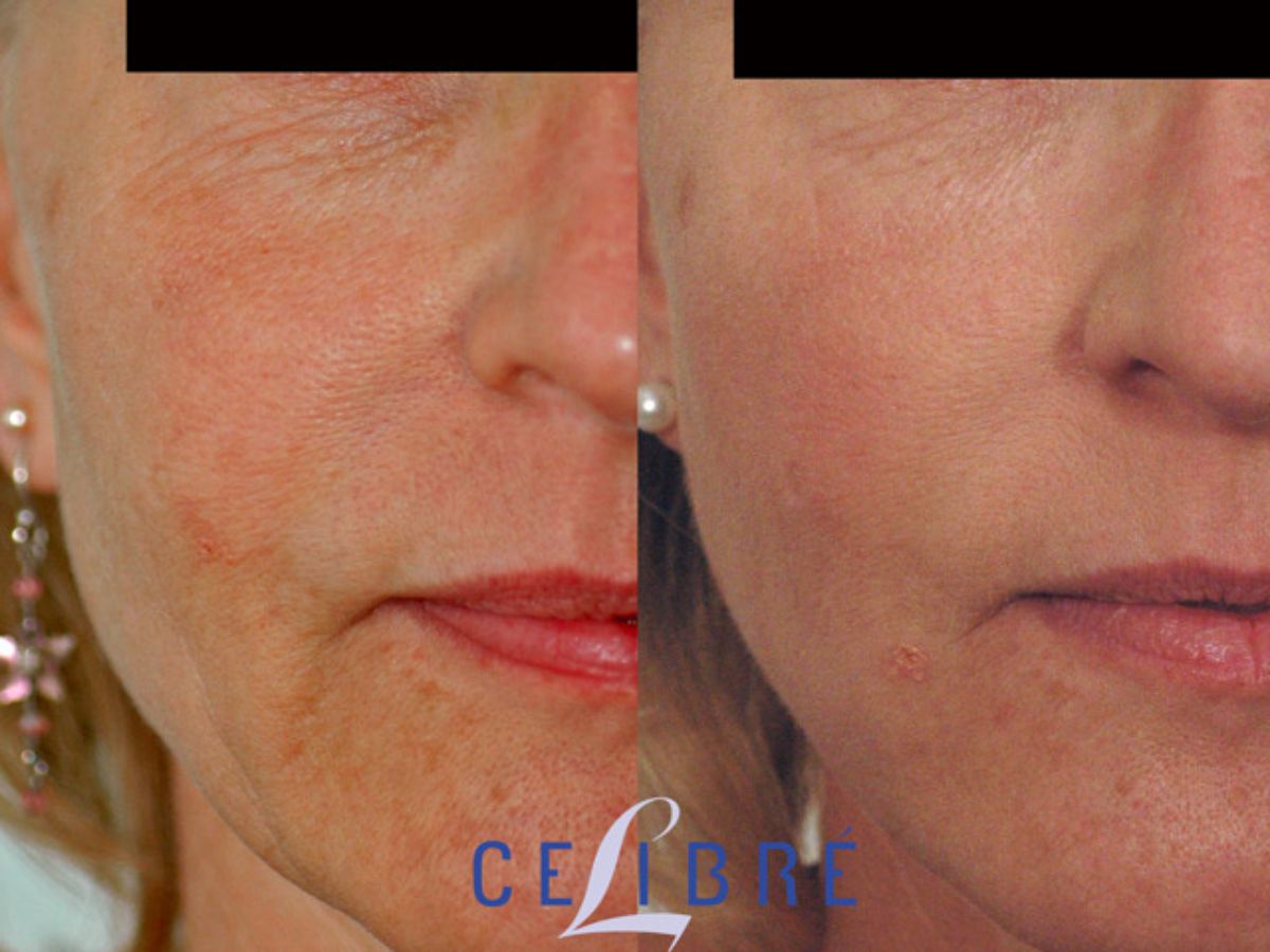 How Long Does Sculptra Last