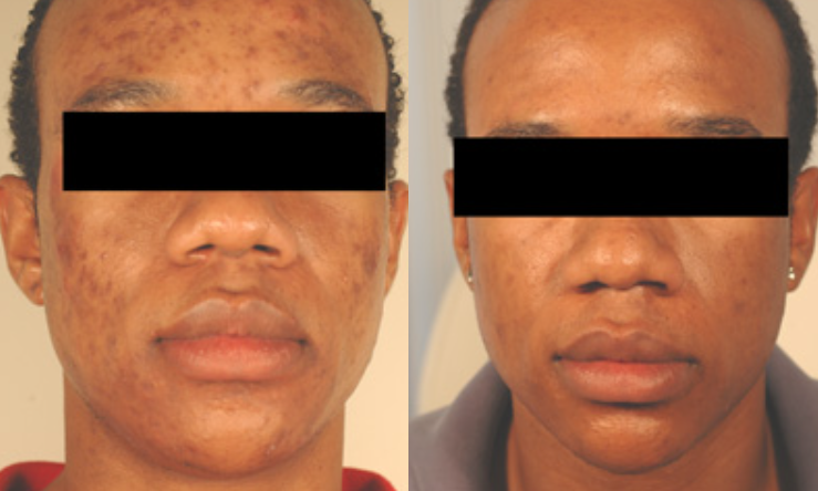 How Many Treatments for Acne Scarring