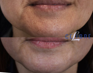 How Much Does Laser Face Resurfacing Cost