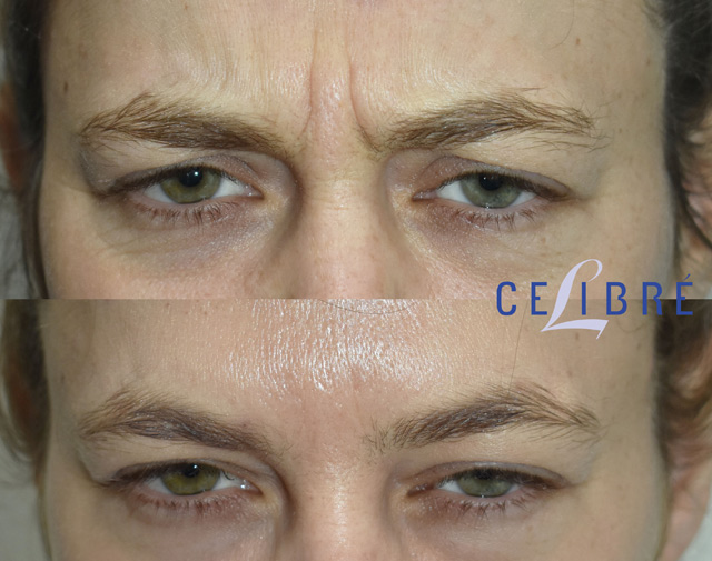 How long until Dysport works