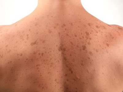 How to Get Rid of Dark Spots on Body