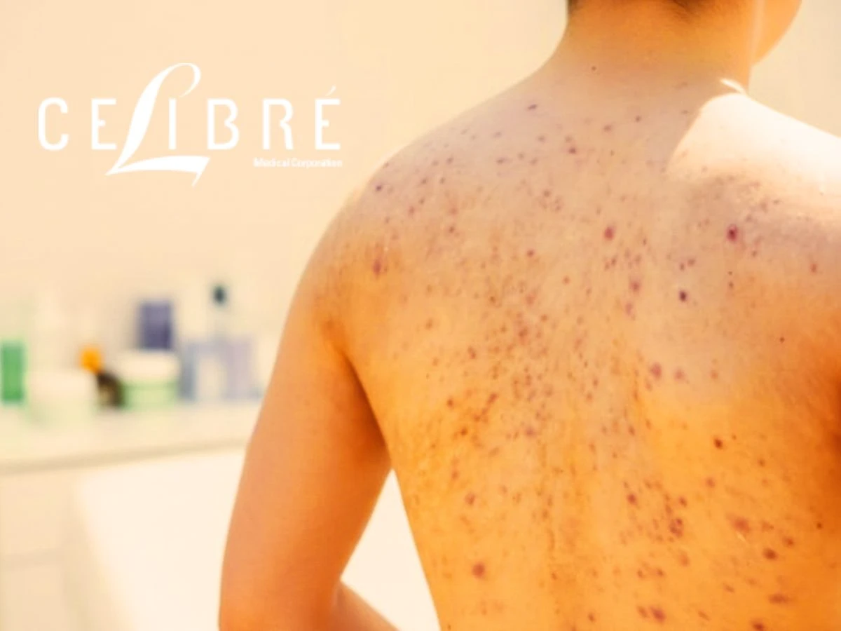 How to Get Rid of Dark Spots on Body