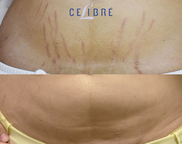 How to Get Rid of Red Stretch Marks