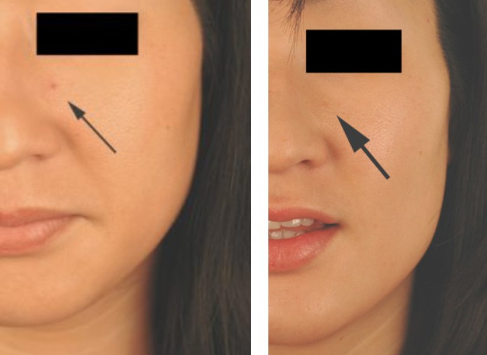 How to Remove Cherry Angioma