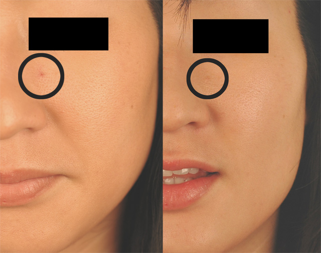 How to Remove Cherry Angiomas