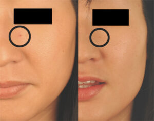 How to Remove Cherry Angiomas