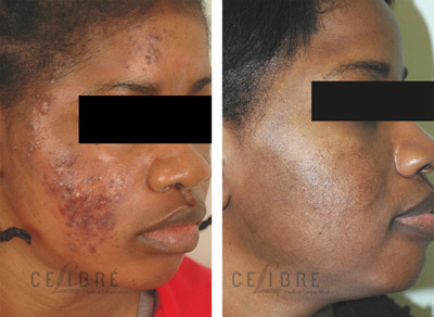 How to Remove Scars from Acne