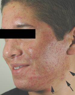 no peeling after pdt