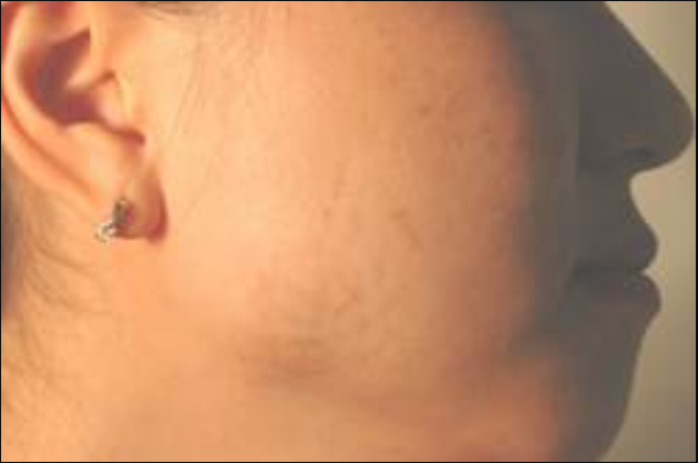 Is Birthmark Laser Removal Right for Me