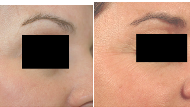 Is There a Cure for Melasma