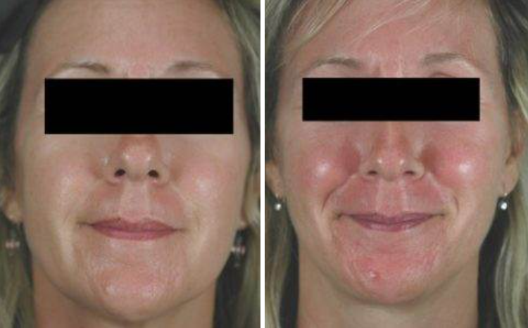 Is There a Cure for Rosacea