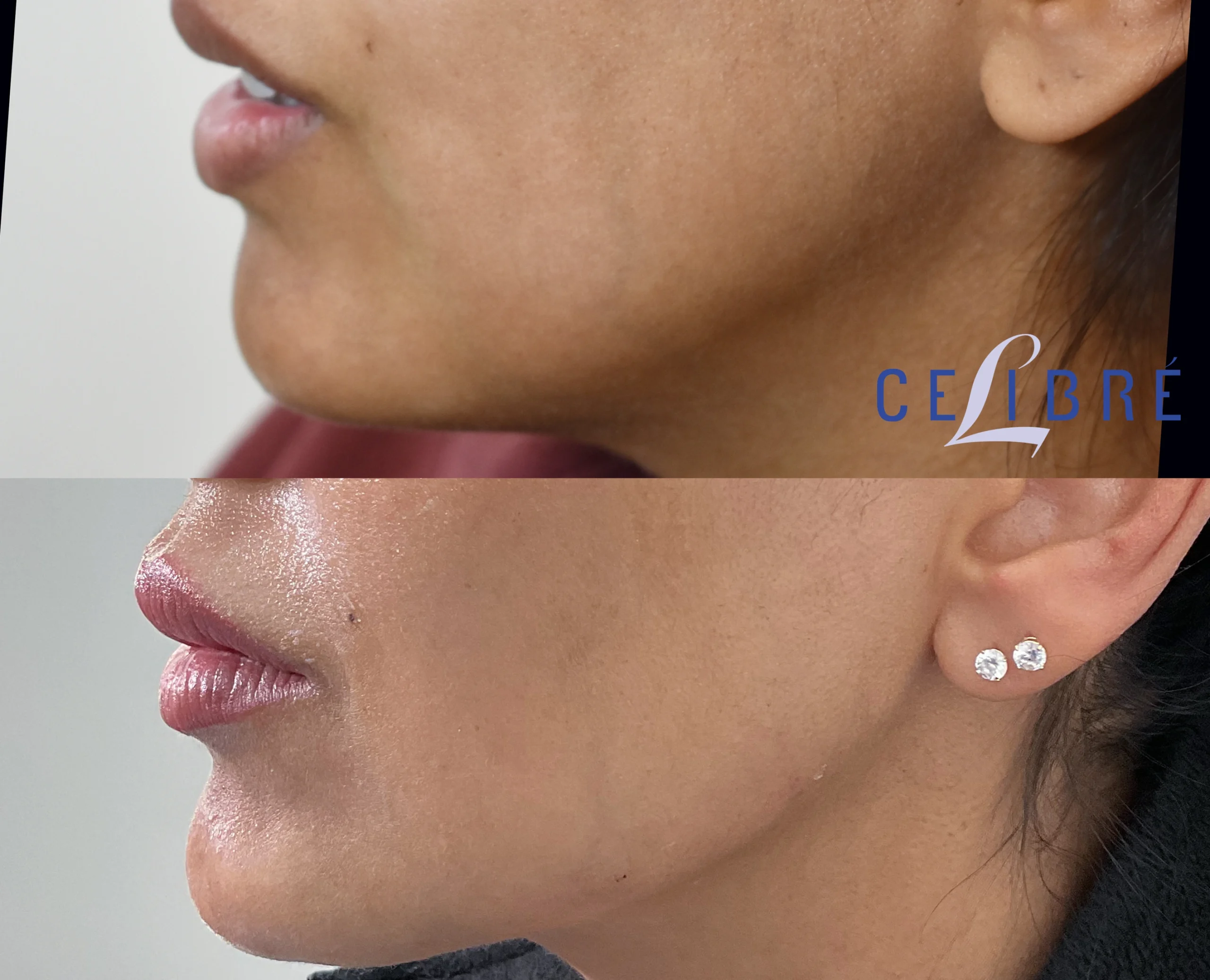 Jaw shaping with Radiesse before after
