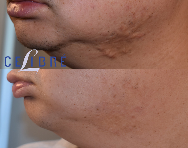 Professional steroid injection treatment helps reduce keloid scars safely for Asian skin with smooth and visible before after results.