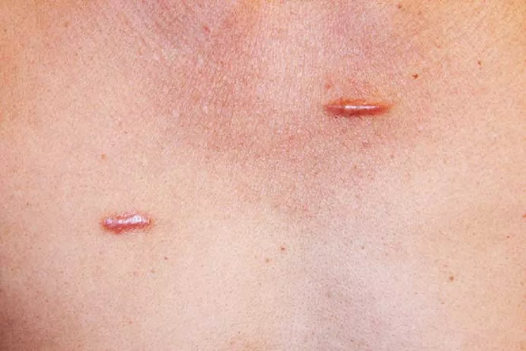 Keloid Scar