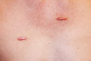 What Causes a Keloid Scar