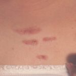 Permanent Keloid Removal